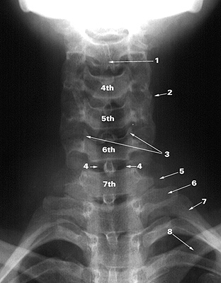 The so-called Joints of Luschka, also known as the Unco-vertebral Joints.