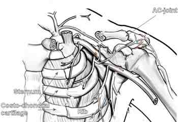 heart attack pain. Chest pain is very common