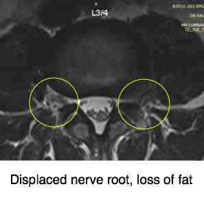 Femoral nerve damage causes severe pain in the buttock and upper