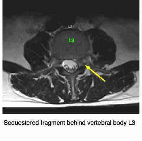 Femoral nerve damage causes severe pain in the buttock and upper