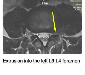 Femoral nerve damage causes severe pain in the buttock and upper