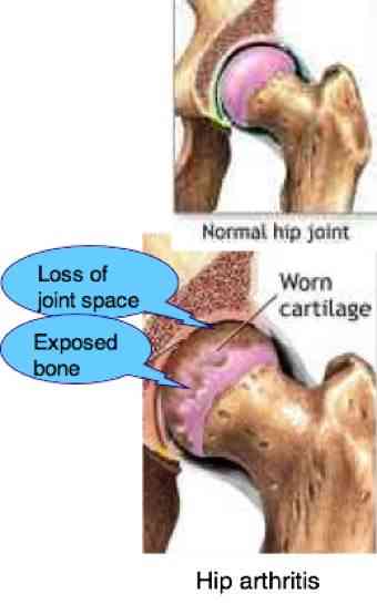 What causes degenerative bone loss?