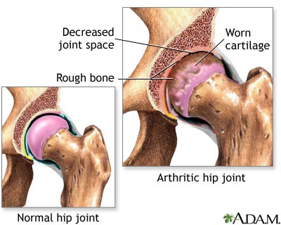 the hip is progressively