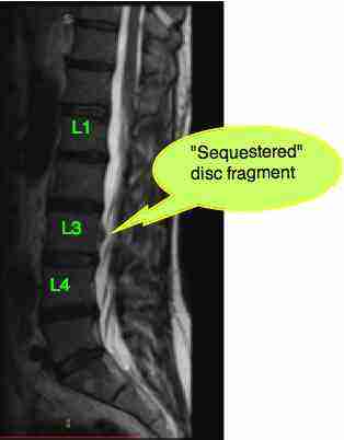 femoral nerve damage causes severe pain in the buttock and upper femoral nerve damage causes severe pain in the buttock and upper, Muscles
