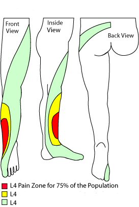 What are the signs and symptoms of a pinched nerve in the leg or back?