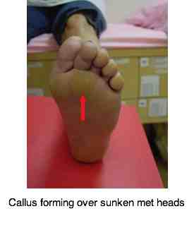 Mortons neuroma causes pain and tingling in the toes and under the