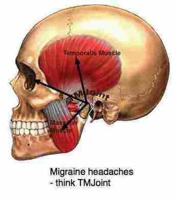 What causes a wisdom tooth infection?