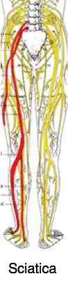Lumbar Facet Arthropathy Spondylolysthesis causes lower back and leg pain.