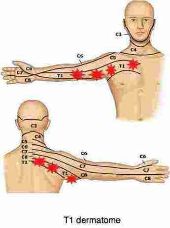 Deltoid+Dermatome Post Traumatic Neuropathy implies nerve pain 