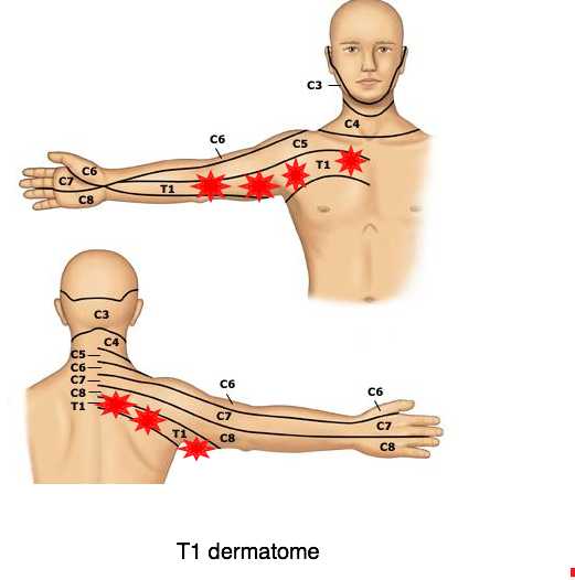 Nerve Pain: Nerve Pain Inner Upper Arm