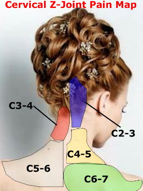 cervical facet pain