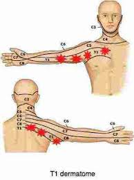 Pins And Needles In My Right Arm 10