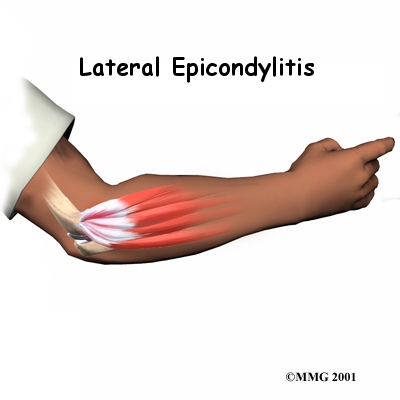 Tennis Elbow is not just for
