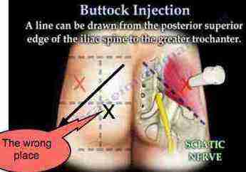 Inject steroids in glute