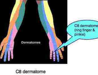 whiplash neck injury and numbness of ring finger and pinkie