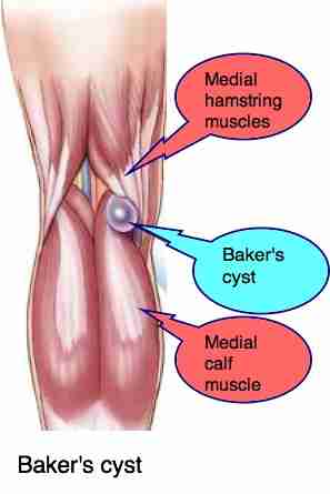 Bakers cyst knee can cause very sharp pain behind the leg.