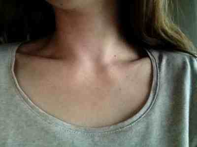 Titze Syndrom Titze Syndrom