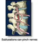 subluxation ed