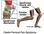 Knee-pain-quadriceps-mechanism.jpg