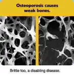 Osteoporosis-weak-brittle-bones.jpg