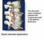 Stenosis spinal exaplanation