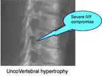 UncoVertebral-hypertrophy.jpg