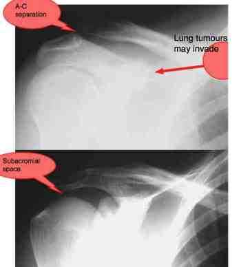 Acromioclavicular separation. Acromioclavicular separation.