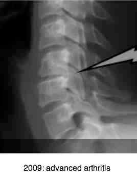 Immobilisation arthritis is indistinguishable from osteo.
