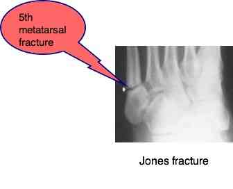 An example of a jones fracture.