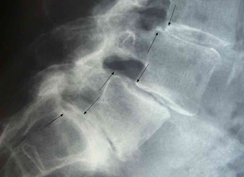X-ray of the spine showing an anterolysthesis at three levels.