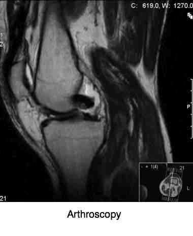 Arthroscopy of the knee joint. Arthroscopy of the knee joint.