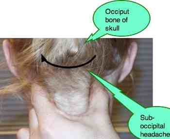 Head Pain Back Of Head Occipital Neuralgia Head Pain Back Of Head Occipital Neuralgia