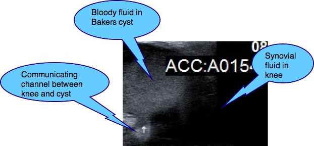 Baker's cyst rupture Baker's cyst rupture