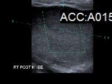 Baker's cyst ultrasound scan Baker's cyst ultrasound scan