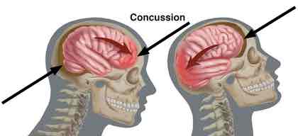 Brain injury in whiplash. Brain injury in whiplash.