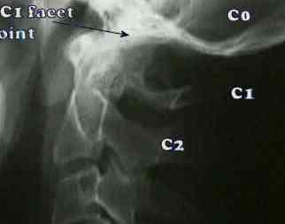 Atlanto Occipital Joint Is A Common Cause Of Headaches