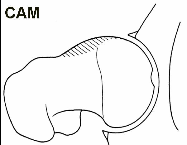 CAM deformity causing hip pain. CAM deformity causing hip pain.