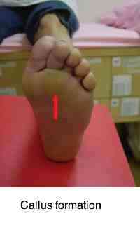A callus as a source of foot pain. A callus as a source of foot pain.