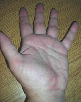 A swollen hand after carpal tunnel surgery. A swollen hand after carpal tunnel surgery.