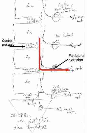 Femoral nerve damage causes severe pain in the upper anterior thigh.