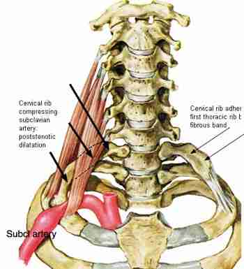 Rib pain causes may be inherited as from a scoliosis or from trauma.