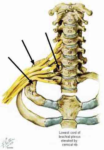 Cervical ribs are an uncommon anomaly causing pain tingling in arms and