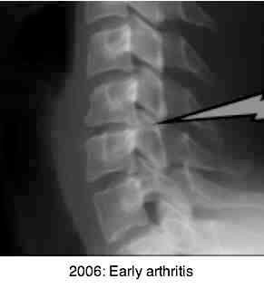 Early facet joint arthritis in cervical spine. Early facet joint arthritis in cervical spine.