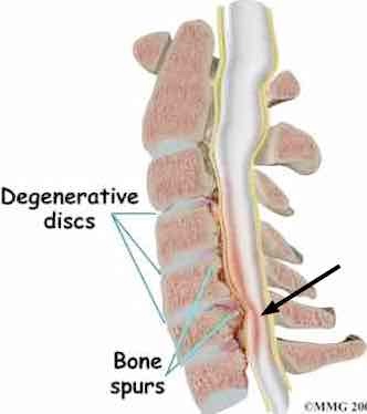 Cervical stenosis graphic.