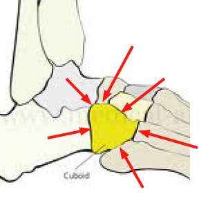 The cuboid is a major source of food pain. The cuboid is a major source of food pain.