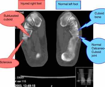 Cuboid subluxation treatment. Cuboid subluxation treatment.