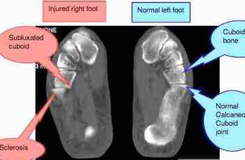 An MRI of the foot showing a cuboid subluxation after an ankle sprain. An MRI of the foot showing a cuboid subluxation after an ankle sprain.