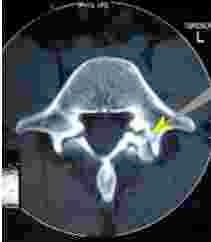 Degenerative joint arthritis. Degenerative joint arthritis.