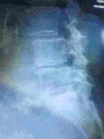 Degenerative spondylolysthesis as seen on a lateral x-ray. Degenerative spondylolysthesis as seen on a lateral x-ray.