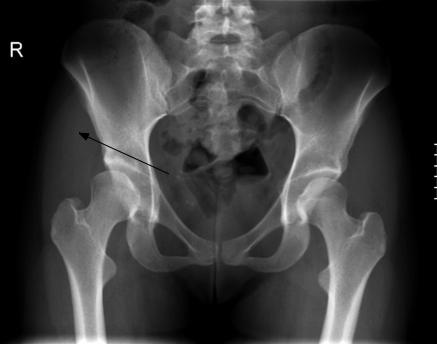 How Do Dogs Get Hip Dysplasia How Do Dogs Get Hip Dysplasia